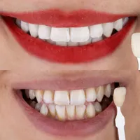 سفید کردن دندان (بلیچینگ)|خدمات آرایشگری و زیبایی|فولادشهر, B2|دیوار
