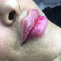 تخفیفات ژل وبوتاکس برای خانمهاواقایون|خدمات آرایشگری و زیبایی|قرچک, مهدیه|دیوار