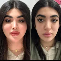 تزریق چربی،ژل،بوتاکس و میدفیس توسط پزشک