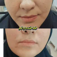 جشنواره بوتاکس/فیلر/مزوتراپی/پی آر پی  توسط پزشک|خدمات آرایشگری و زیبایی|زنجان, |دیوار