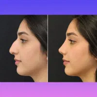 کرم لیفت و کوچک کننده بینی