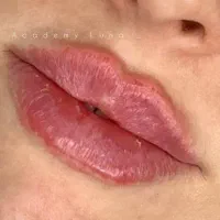 فیلر و بوتاکس