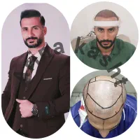 جشنواره کاشت مو طرح همدلی فرصت ویژه فول تراکم