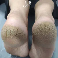 پاکسازی سازی پا با پدیکور