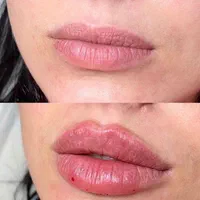 مدل تزریق ژل و بوتاکس و آموزش در کلینیک زیبایی|خدمات آرایشگری و زیبایی|کرج, چهارصد دستگاه|دیوار