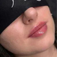 جشنواره ژل و بوتاکس تضمینی