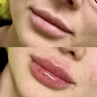 فیلر لب و صورت