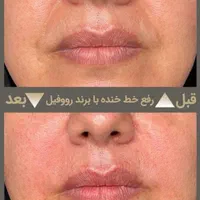 تزریق حرفه ای فیلر در کلینیک زیبایی و لیزر راویس|خدمات آرایشگری و زیبایی|کاشان, رجایی|دیوار