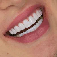 دندانپزشکی.کامپوزیت.روکش دندان.لمینت.ترمیم|خدمات آرایشگری و زیبایی|کرمانشاه, |دیوار