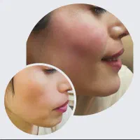 ژل،بوتاکس،پی آرپی،میکرونیدلینگ|خدمات آرایشگری و زیبایی|اصفهان, خانه اصفهان|دیوار