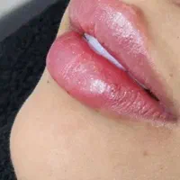 خدمات زیبایی فیلرلب، زاویه ، مید فیس، بوتاکس