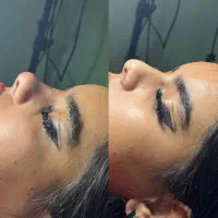 ژل و بوتاکس