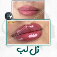 فیلر(ژل) لب گونه چانه خط خنده زاویه توسط پزشک رشت|خدمات آرایشگری و زیبایی|رشت, گلسار|دیوار