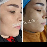 پاکسازی و فیشال /درمان جوش و لک و منافذباز|خدمات آرایشگری و زیبایی|کرمانشاه, |دیوار