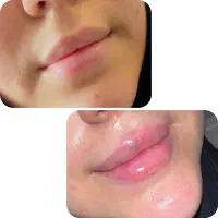 تزریق ژل تخفیف ویژه