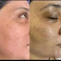 جوانسازی با پی آرپی و لایه برداری پوست  فقط۳۹۹|خدمات آرایشگری و زیبایی|اصفهان, طامه|دیوار