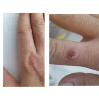 معجزه درمان بیماری hpv و hsv