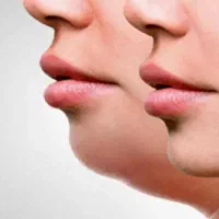 جراحی پلک،غبغب،لیفت نخ،بوتاکس و فیلر نیشابور