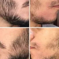 معجزه آور ریش و مو