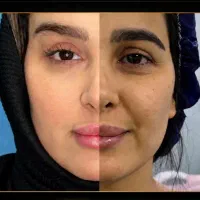 جشنواره تخفیف فوق العاده جراحی لیفت صورت(فیس لیفت)