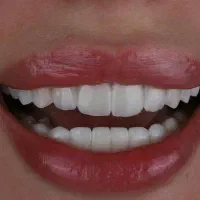 کامپوزیت دندان|خدمات آرایشگری و زیبایی|ری, دیلمان|دیوار