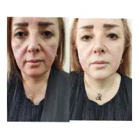 تخفیف پاییزی هایفو تراپی کلینیک پاپیون اسلامشهر