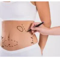 پیکر تراشی لیپوماتیک و تزریق چربی با اقساط 12 ماهه