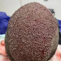 کاشت مو اقاسطی با استثنایی ترین قیمت