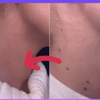 برداشتن خال انواع خال لیزر تتو