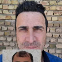 کاشت مو