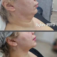 جوانسازی پوست با ترکیب قدرتمند هایفوتراپی + PRP|خدمات آرایشگری و زیبایی|تهران, هفت حوض|دیوار