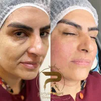 لیفت و جوانسازی صورت هایفو توسط پزشک