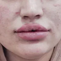 تزریق ژل لب.گونه.چانه.زاویه سازی فک.آنزیم بینی|خدمات آرایشگری و زیبایی|اردکان, |دیوار