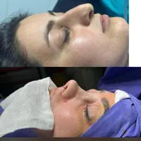 عمل زیبای بینی|خدمات آرایشگری و زیبایی|قائم‌شهر, |دیوار