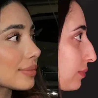 ( جشنواره اقساطی عمل بینی فقط با ۱۰ میلیون )