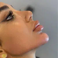 فیلرچانه،کات گونه، ژل لب، بوتاکس
