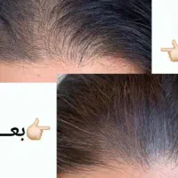 درمان اصولی ریزش مو،ابرو،تا شب یلدا(جایگزین کاشت)