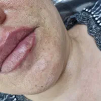 ژل وبوتاکس|خدمات آرایشگری و زیبایی|مشهد, ایثارگران|دیوار