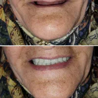 دندان مصنوعی و دندانسازی ، خدمات دندان سازی|خدمات آرایشگری و زیبایی|مشهد, شفا|دیوار