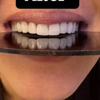 کامپوزیت فکی ۶ تومان