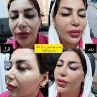 لیفت وجوانسازی با نخ های کاگ و تزریق فیلر ومزوها|خدمات آرایشگری و زیبایی|شیراز, میانرود|دیوار