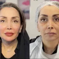 کلینیک جراحی نخ آنزیم غبغب مزو ژل فیلر بوتاکس|خدمات آرایشگری و زیبایی|کرج, گوهردشت|دیوار