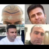 کاشت مو وابروی تخصصی فقط با ۱۳ میلیون تومان|خدمات آرایشگری و زیبایی|تهران, نیلوفر|دیوار