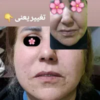 ۲۰ درصد تخفیف خدمات ژل و بوتاکس|خدمات آرایشگری و زیبایی|دوگنبدان, |دیوار