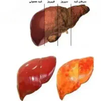 پاکسازی کبد چرب