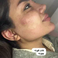 جشنواره ژل و بوتاکس و پی ار پی در مطب توسط پزشک|خدمات آرایشگری و زیبایی|شیراز, چوگیاه|دیوار