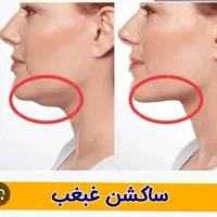 تخفیف ویژه ساکشن و فیلر و بوتاکس