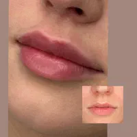 جشنواره تزریق ژل و بوتاکس (تحت نظرپزشک)|خدمات آرایشگری و زیبایی|اصفهان, خلجا|دیوار