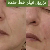 هایفو بوتاکس ژل لب زاویه سازی فیلر بادی هیپ سینه|خدمات آرایشگری و زیبایی|تهران, نارمک|دیوار