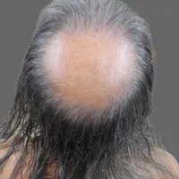 میکرواسکالپ